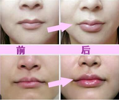 玻尿酸豐唇珠效果怎么樣？玻尿酸豐唇珠多少錢？