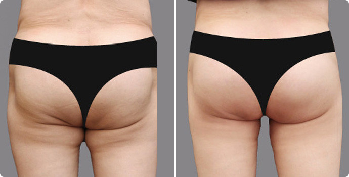 吸脂瘦臀部價格多少？吸脂瘦臀術后如何護理？