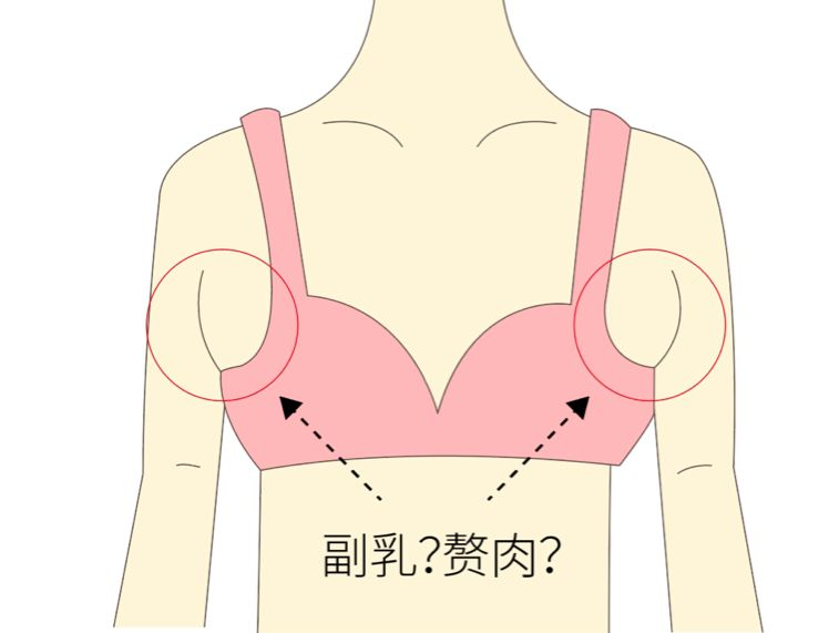 手術去副乳效果怎么樣？手術去副乳要注意什么？
