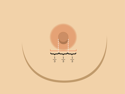 乳暈縮小如何矯正 乳暈縮小術(shù)的注意事項(xiàng)有哪些？