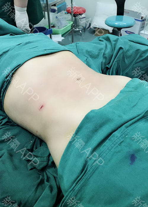 腰腹抽脂效果怎么樣？腰腹抽脂沒有瘦的原因？