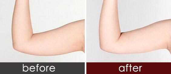 手臂抽脂效果明顯嗎 ？吸脂瘦手臂會(huì)反彈嗎？