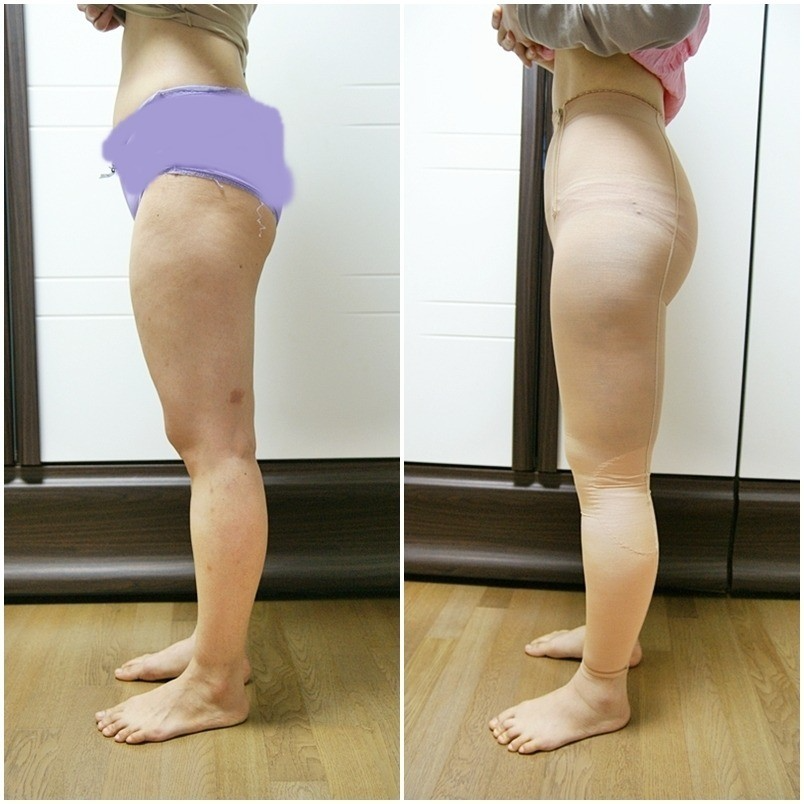 吸脂瘦大腿腫脹期是多久？大腿吸脂有什么后遺癥嗎？