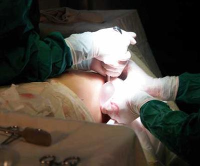 胸部假體取出多久可以重新做 ？胸部假體取出注意事項(xiàng)？