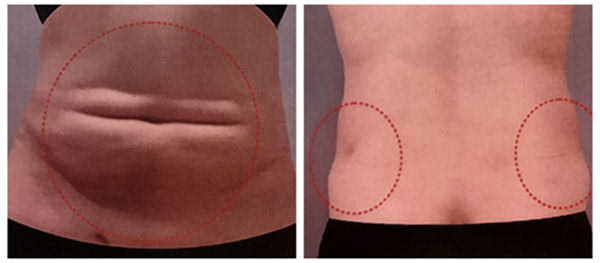 吸脂失敗了多久可以修復(fù)？吸脂失敗修復(fù)怎么解決？