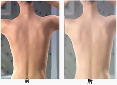 背部吸脂多久恢復？吸脂瘦背部注意事項