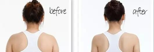 后背抽脂那些人可以做？吸脂瘦肩膀多少錢？