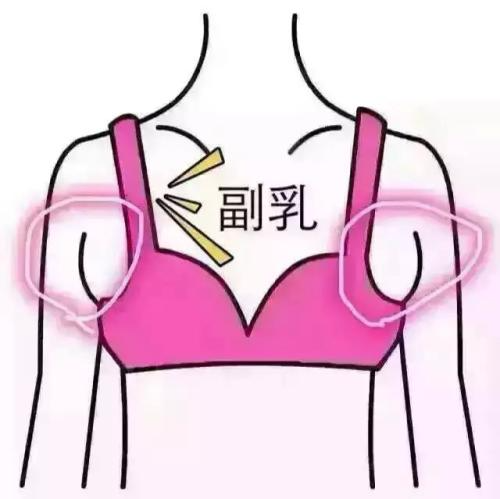 吸脂做副乳要多少錢？吸脂去副乳會反彈嗎？