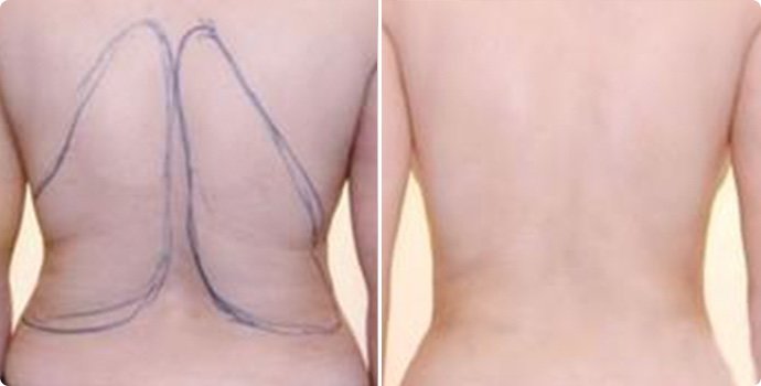 射頻溶脂瘦后背術(shù)多少錢(qián) 射頻溶脂瘦后背術(shù)后需要注意什么