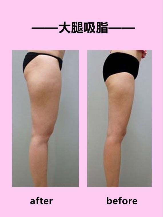 吸脂瘦大腿腫脹期是多久？大腿吸脂有什么后遺癥嗎？