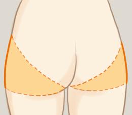 射頻溶脂瘦臀部的優(yōu)缺點(diǎn) 射頻溶脂有哪些功效 射頻溶脂瘦臀部的優(yōu)缺點(diǎn) 射頻溶脂有哪些功效