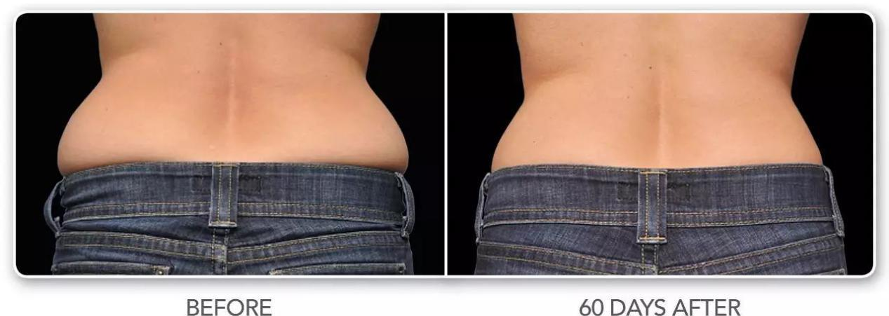 冷凍溶脂瘦臀部的效果怎么樣  冷凍溶脂瘦臀部需要注意什么