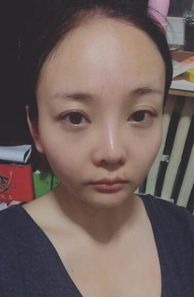 熱瑪吉案例整形前效果