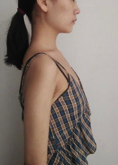 上海藝星醫(yī)療美容醫(yī)院郭仁洙隆胸案例效果分享