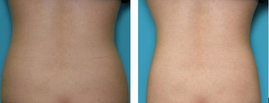 隔空溶脂瘦腰多少天見效 隔空溶脂瘦腰有什么副作用