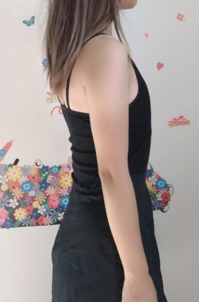 上海德琳醫(yī)療美容醫(yī)院假體隆胸手術(shù)效果前