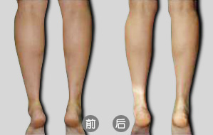 隔空溶脂瘦小腿后如何術(shù)后護(hù)理  隔空溶脂瘦小腿多少錢(qián)
