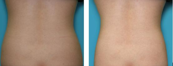 隔空溶脂瘦腰多少天見效 隔空溶脂瘦腰有什么副作用