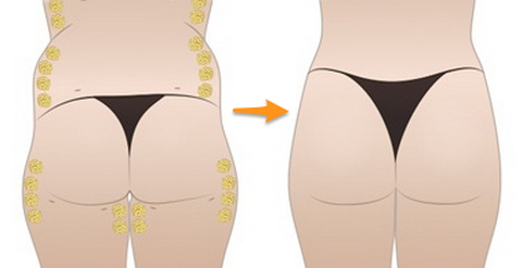 自體脂肪豐臀后會不會變形呢？自體脂肪豐臀的優(yōu)缺點(diǎn)有哪些？