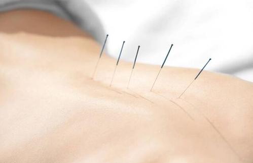 埋線減肥多少錢一次？埋線減肥多久才能有效果