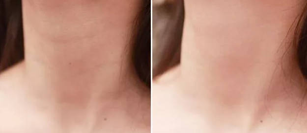 嗨體去頸紋幾天有效果 嗨體去頸紋如何延長(zhǎng)維持時(shí)間