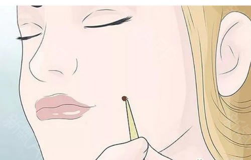 激光點痣要多久才會恢復？激光點痣多少錢？