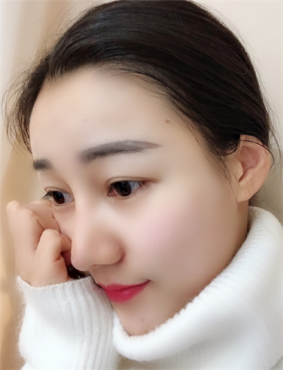 長春中妍醫(yī)療美容醫(yī)院隆鼻最終效果