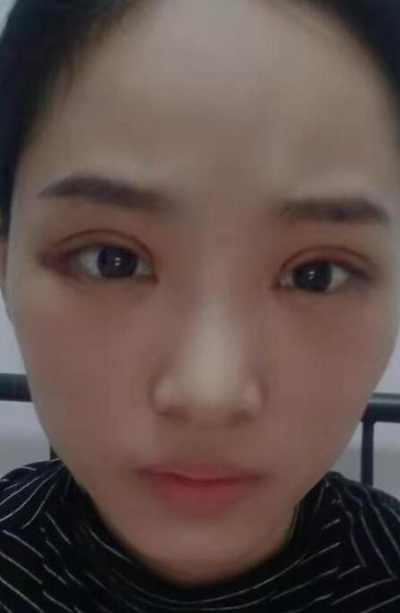  長沙星雅醫(yī)療美容醫(yī)院做雙眼皮手術后恢復情況