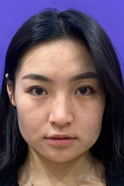 上海美萊醫(yī)療美容門診部熊師熱瑪吉案例效果分享