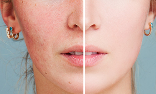 北京阿露絲醫(yī)療美容怎么樣？紅藍(lán)光祛痘紅藍(lán)光有何區(qū)別？