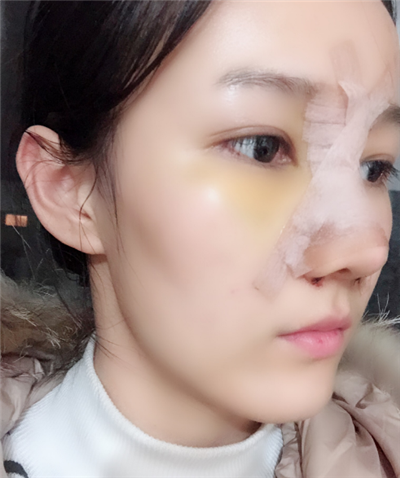 長春中妍醫(yī)療美容醫(yī)院王軍隆鼻案例效果分享