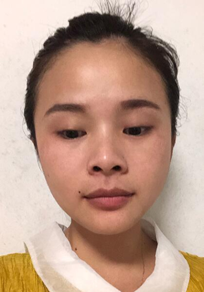 長(zhǎng)春中妍醫(yī)療美容醫(yī)院做雙眼皮手術(shù)前的眼睛