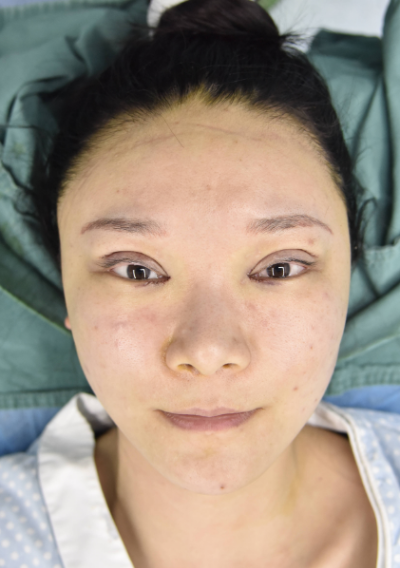  寧波尚美整形美容醫(yī)院做雙眼皮手術(shù)剛做完后