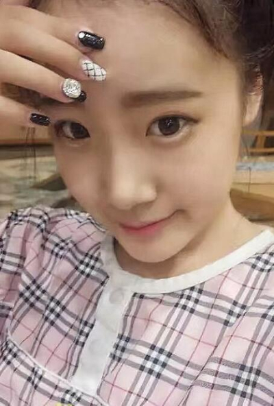 蘇州愛思特醫(yī)療美容醫(yī)院做隆鼻手術(shù)前的鼻子