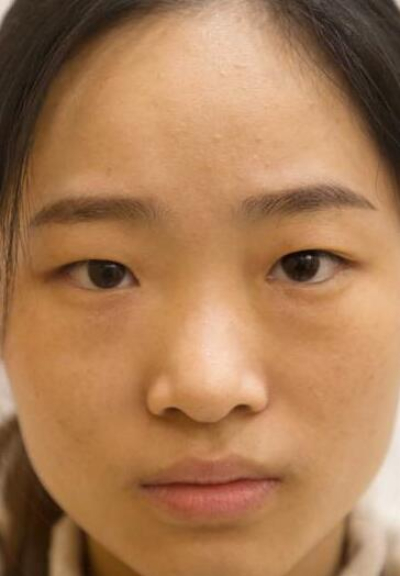  長沙星雅醫(yī)療美容醫(yī)院做雙眼皮手術前