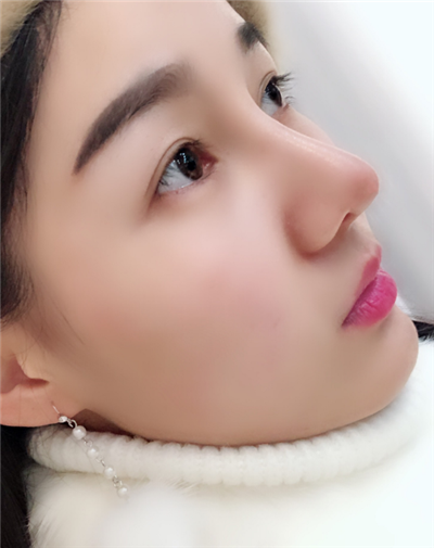 長春中妍醫(yī)療美容醫(yī)院隆鼻手術后鼻子情況基本穩(wěn)定