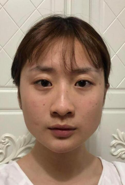 珠海陸達美容外科醫(yī)院陳越文下頜骨案例效果分享