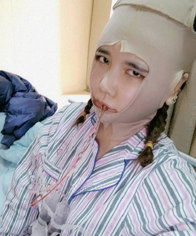 上海藝星醫(yī)療美容醫(yī)院做顴骨降低手術剛剛結束后 上海藝星醫(yī)療美容醫(yī)院做顴骨降低手術剛剛結束后