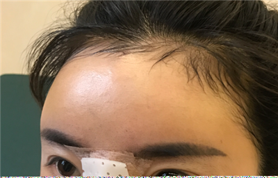 煙臺(tái)壹美整形美容醫(yī)院做隆鼻手術(shù)后的鼻子狀態(tài)