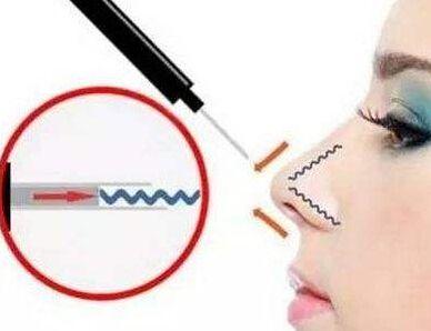 成都博雅整形埋線隆鼻有哪些優(yōu)勢(shì)？成都博雅埋線隆鼻疼嗎？