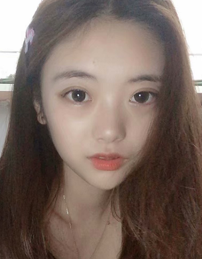 安徽韓美整形美容醫(yī)院做雙眼皮最終效果