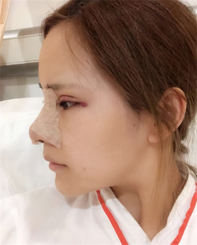 深圳弘美醫(yī)療美容門(mén)診部做眼綜合手術(shù)后