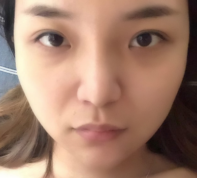 寧波尚美整形美容醫(yī)院做隆鼻手術(shù)后的一周