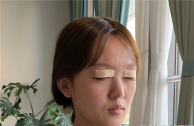 慈溪悅爾醫(yī)學(xué)美容醫(yī)院趙天宇雙眼皮案例效果分享