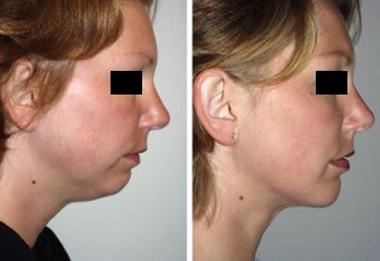 成都當(dāng)代整形透明質(zhì)酸墊下巴效果？ 透明質(zhì)酸墊下巴多少錢？