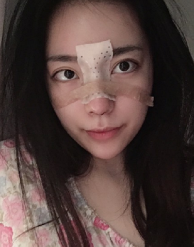 成都漢密爾頓美容醫(yī)院做鼻修復(fù)手術(shù)后