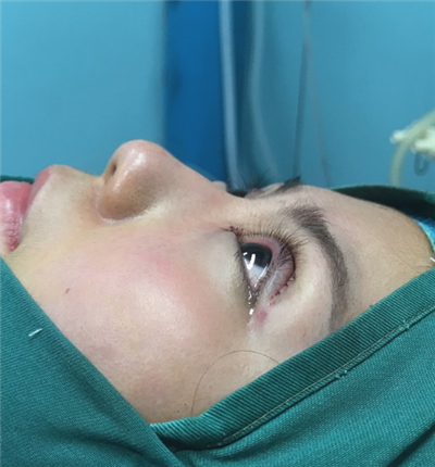 溫州友好醫(yī)院整形美容中心陳瑤雙眼皮案例效果分享