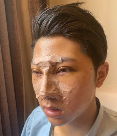 長(zhǎng)春中妍醫(yī)療美容醫(yī)院做鼻綜合手術(shù)后