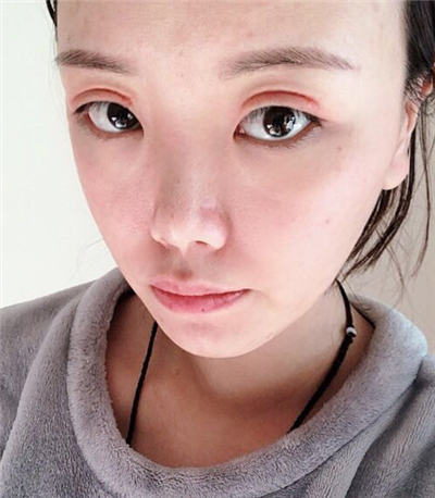 珠海韓妃醫(yī)療美容門(mén)診部李友良雙眼皮案例效果分享