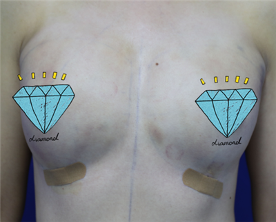 煙臺壹美整形美容醫(yī)院馬福順隆胸案例效果分享